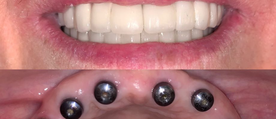 Full Arch Implant Peri-implantitis