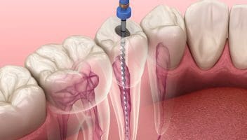 root canal treatment