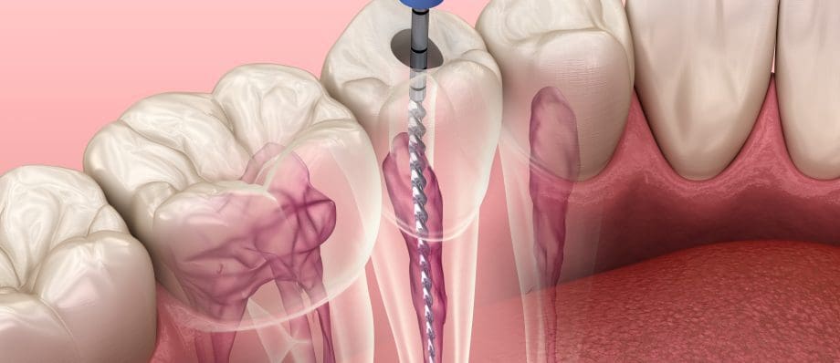 root canal treatment