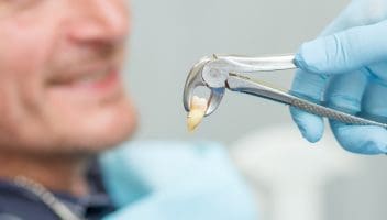 tooth extraction