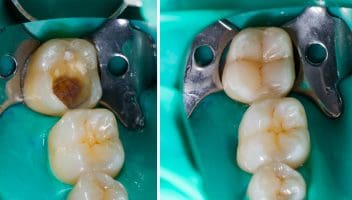 dental composite