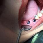 flapless implant