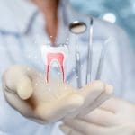 avoid root canal