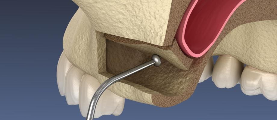 sinus lift surgery