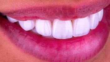 dental laminates