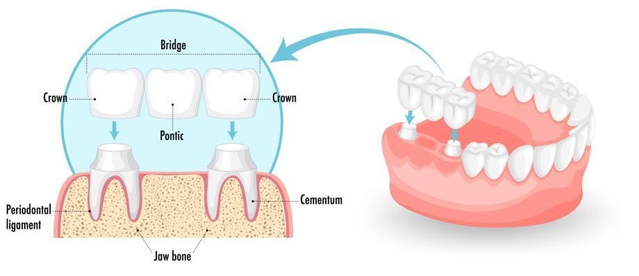 dental bridge