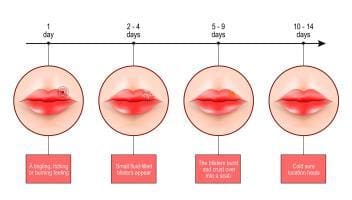 cold sores stages