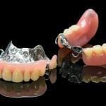removable partial denture
