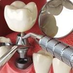 dental implant procedure