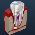 root canal retreatment