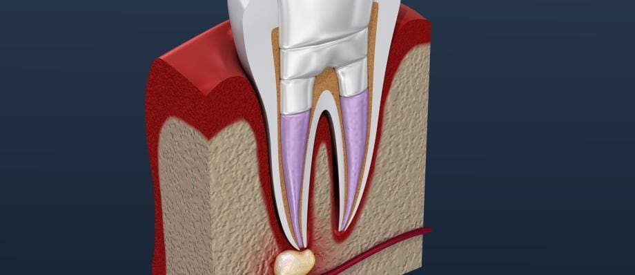 root canal retreatment