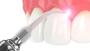 dental laser uses