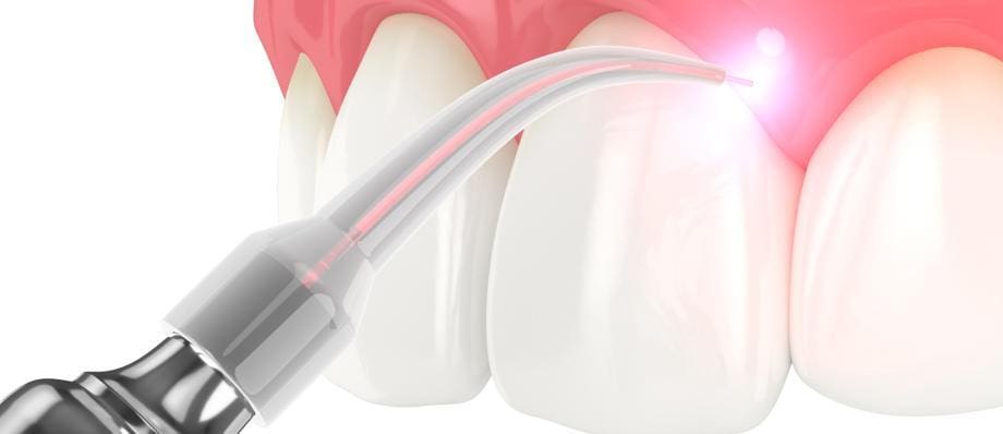 dental laser uses