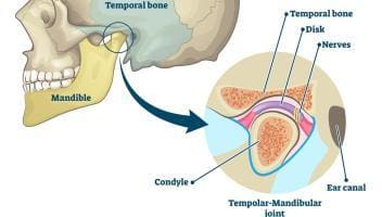 TMJ disorder