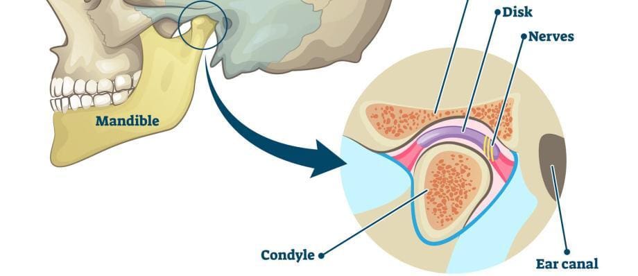 TMJ disorder