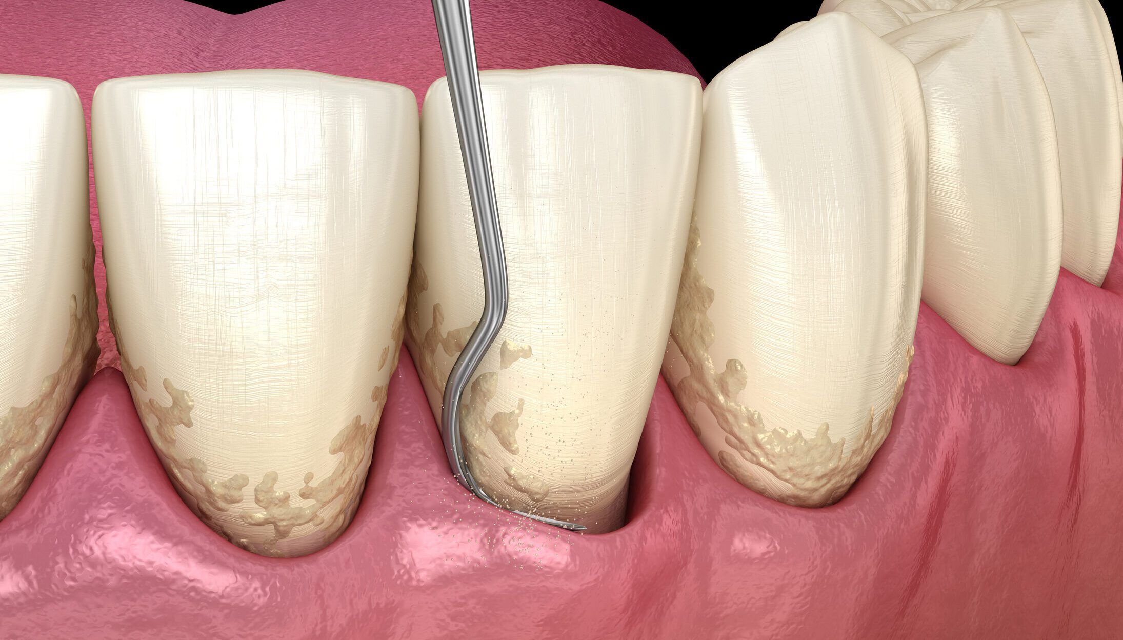 Gingival Curettage An Indepth Analysis of a Dental Procedure