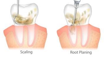 scaling and root planing