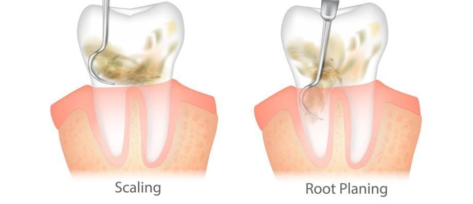 scaling and root planing