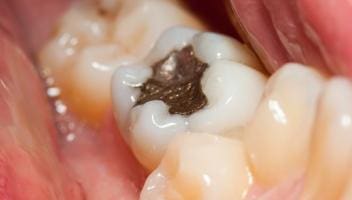 dental amalgam