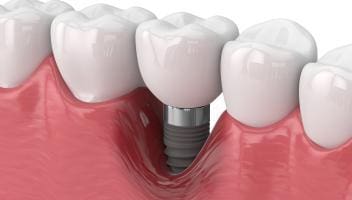 dental implant failure