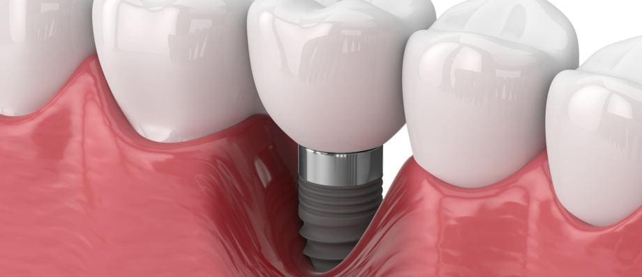 Dental Implant Failure