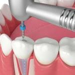 rotary in root canals