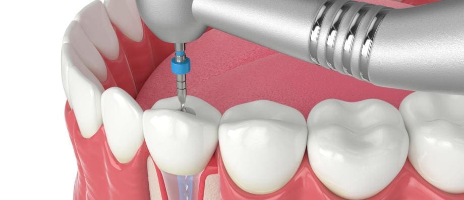 rotary in root canals