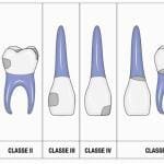 tooth cavities class