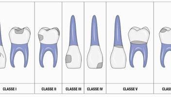 tooth cavities class