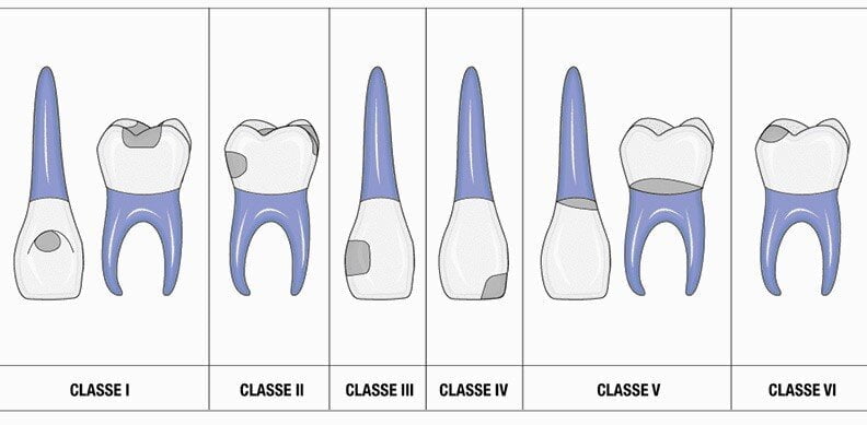 tooth cavities class