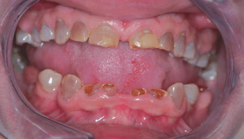 dentinogenesis imperfecta