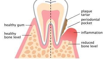 periodontitis