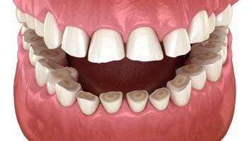 dental erosion