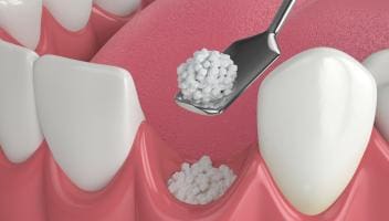 bone graft