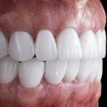 dental occlusion