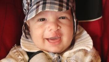 cleft lip and palate