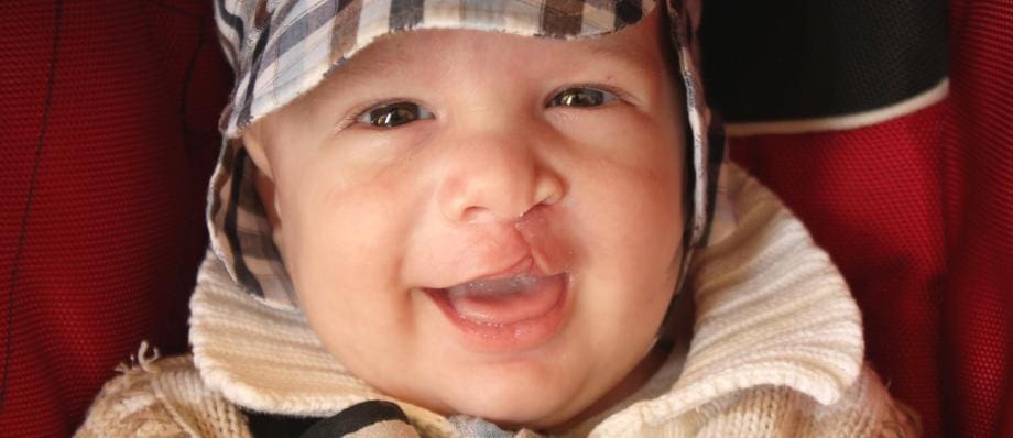 cleft lip and palate