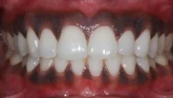 dark gums