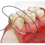 suturing