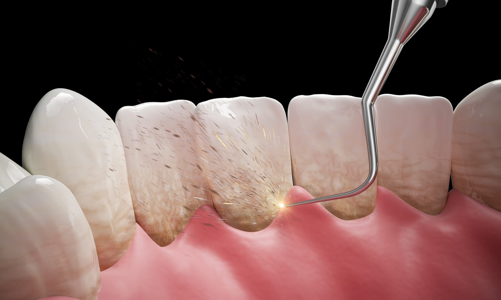 Tooth Calculus (Tartar): Causes, Effects, Prevention, and Removal