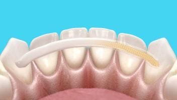 splinting teeth