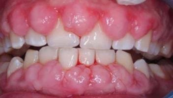 gingival hyperplasia