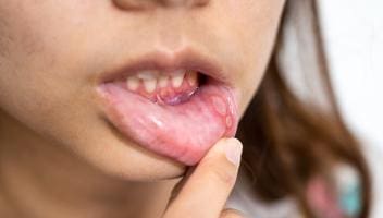 mouth ulcers