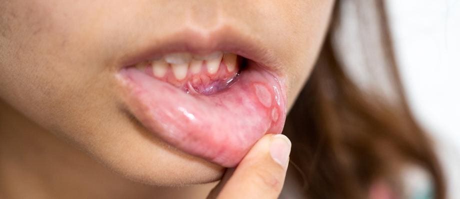 mouth ulcers