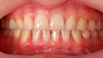 healthy gums