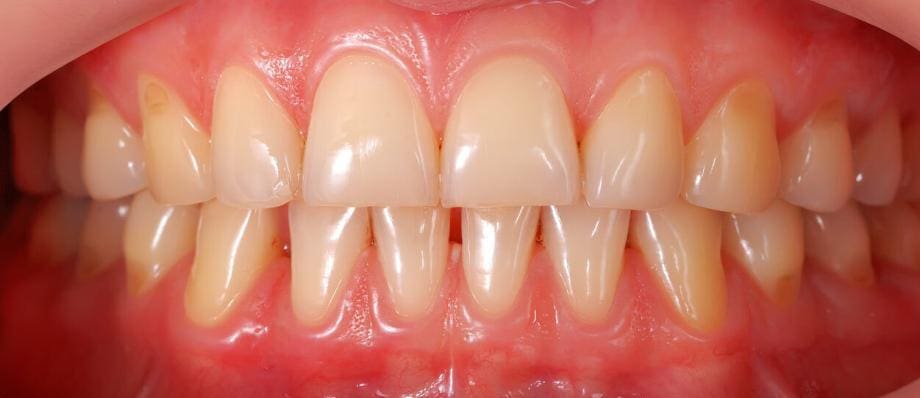 healthy gums