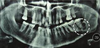 ameloblastoma