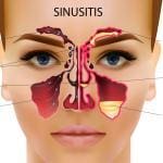 sinus infections