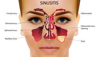 sinus infections