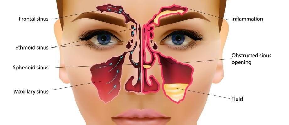 Sinus Infections Causes Symptoms Treatment And Prevention
